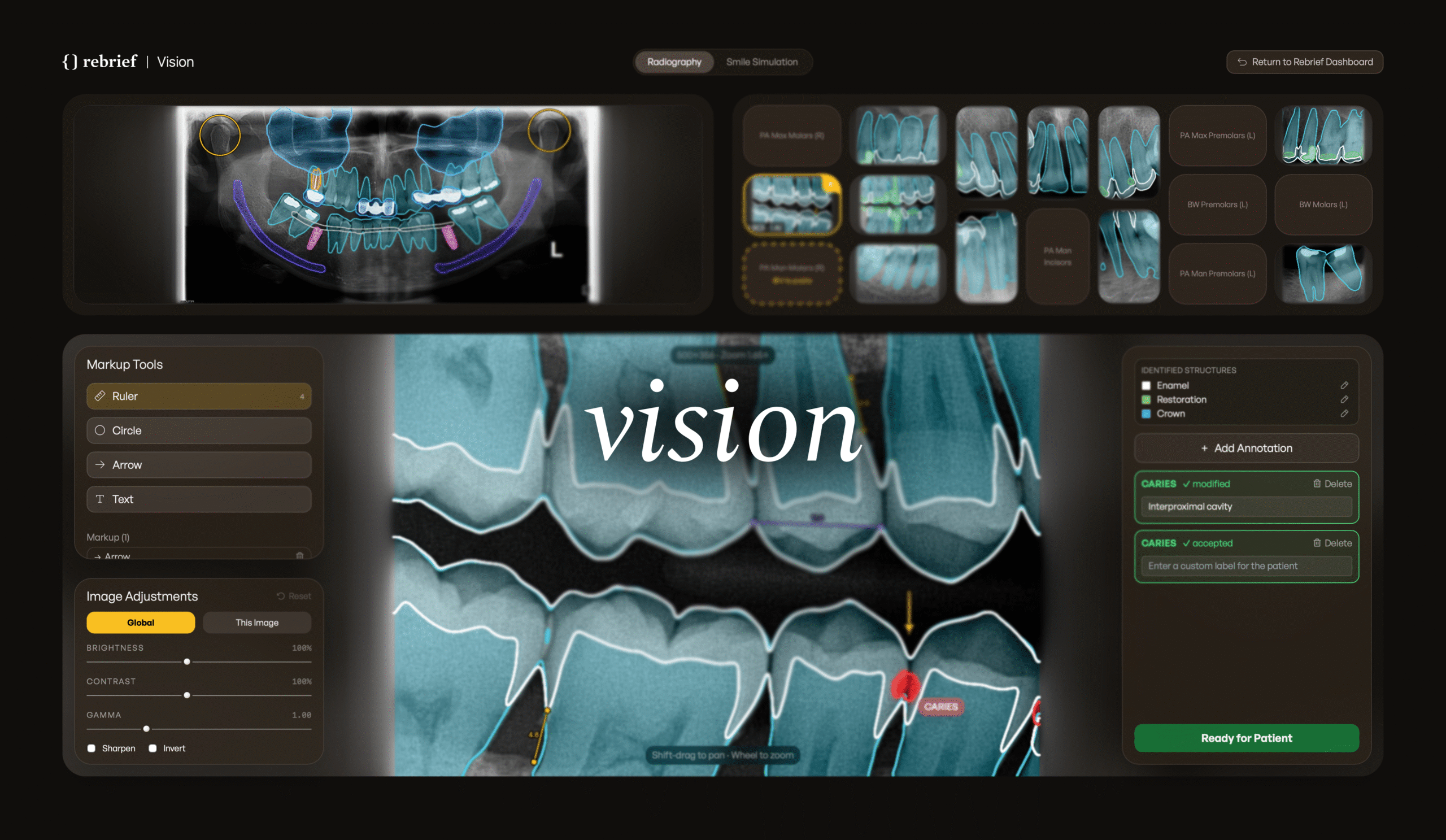 Introducing Rebrief Vision: An All-in-One Case Presentation Platform for Modern Dental Practices